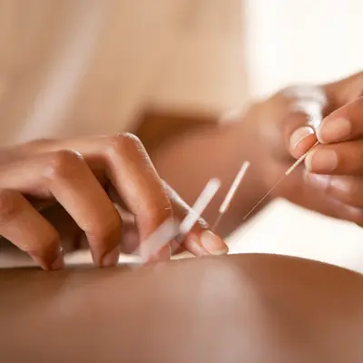 Acupuncture. Acupuncturist inserting a needle into a client's back. This traditional Chinese practice uses needles to restore an energy flow through specific points on the skin. It is used to relieve pain and to treat a wide range of disorders. Modern Western medicine explains the pain-relieving effects by suggesting that the needles stimulate the release of endorphins, the body's natural painkillers.