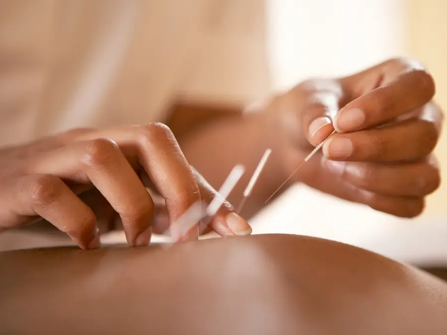 Acupuncture. Acupuncturist inserting a needle into a client's back. This traditional Chinese practice uses needles to restore an energy flow through specific points on the skin. It is used to relieve pain and to treat a wide range of disorders. Modern Western medicine explains the pain-relieving effects by suggesting that the needles stimulate the release of endorphins, the body's natural painkillers.