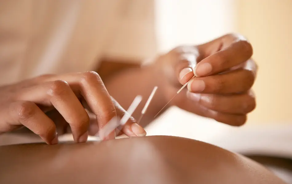 Acupuncture. Acupuncturist inserting a needle into a client's back. This traditional Chinese practice uses needles to restore an energy flow through specific points on the skin. It is used to relieve pain and to treat a wide range of disorders. Modern Western medicine explains the pain-relieving effects by suggesting that the needles stimulate the release of endorphins, the body's natural painkillers.
