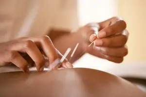 Acupuncture. Acupuncturist inserting a needle into a client's back. This traditional Chinese practice uses needles to restore an energy flow through specific points on the skin. It is used to relieve pain and to treat a wide range of disorders. Modern Western medicine explains the pain-relieving effects by suggesting that the needles stimulate the release of endorphins, the body's natural painkillers.